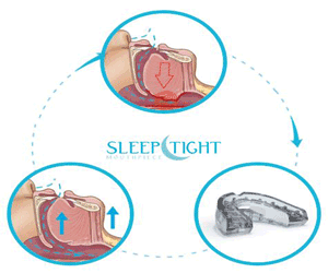 Sleeptight Mouthpiece Promo